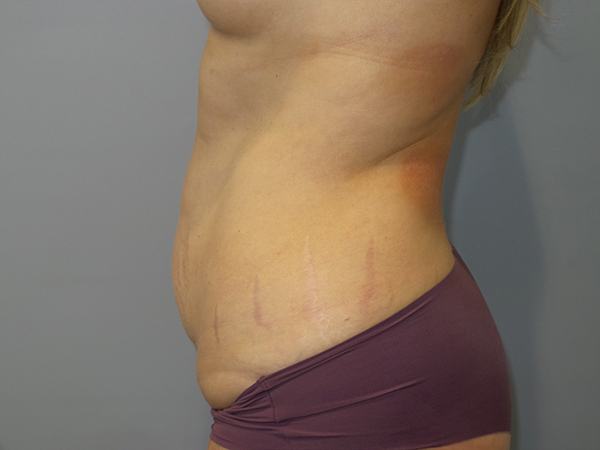 Tummy Tuck Before and After 108 | Sanjay Grover MD FACS