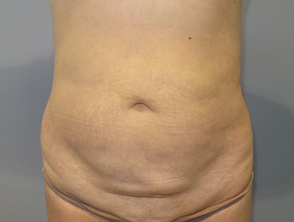 Tummy Tuck Before and After | Grover Aesthetics