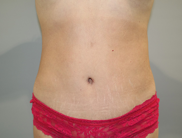 Tummy Tuck Before and After | Grover Aesthetics