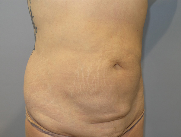 Tummy Tuck Before and After 109 | Grover Aesthetics