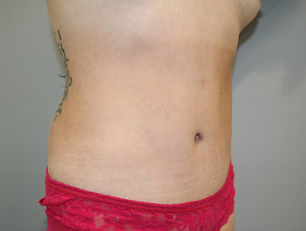 Tummy Tuck Before and After 109 | Sanjay Grover MD FACS