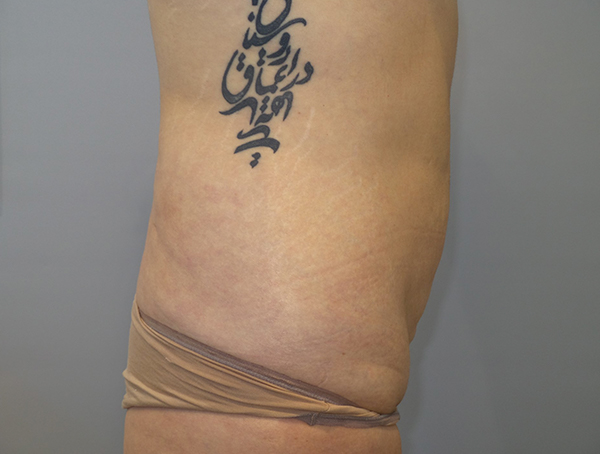 Tummy Tuck Before and After 109 | Grover Aesthetics