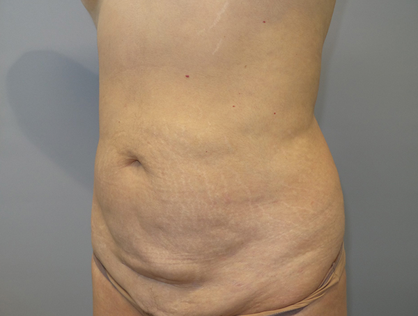 Tummy Tuck Before and After 109 | Sanjay Grover MD FACS