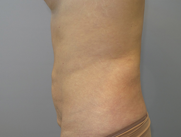Tummy Tuck Before and After 109 | Grover Aesthetics