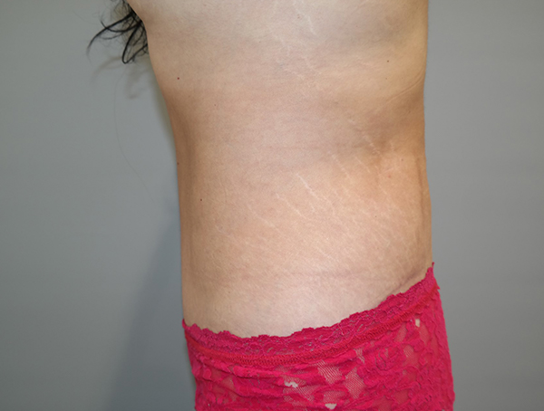 Tummy Tuck Before and After 109 | Grover Aesthetics