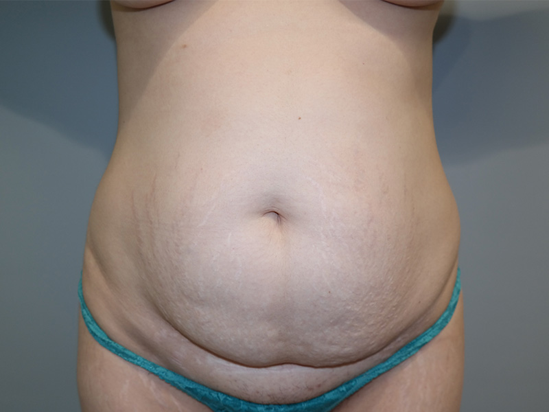 Tummy Tuck Before and After 76 | Sanjay Grover MD FACS