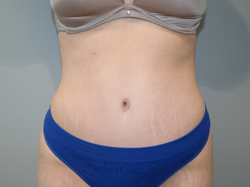 Tummy Tuck Before and After | Grover Aesthetics