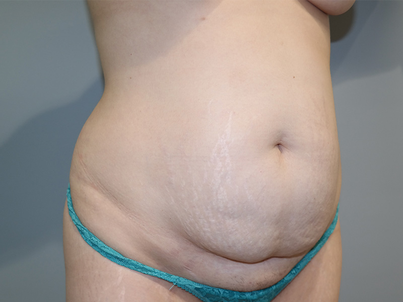 Tummy Tuck Before and After 11 | Grover Aesthetics