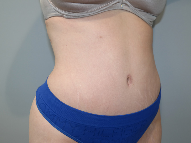 Tummy Tuck Before and After 11 | Sanjay Grover MD FACS