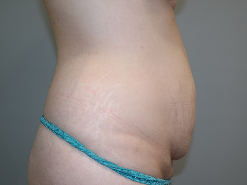 Tummy Tuck Before and After 11 | Sanjay Grover MD FACS