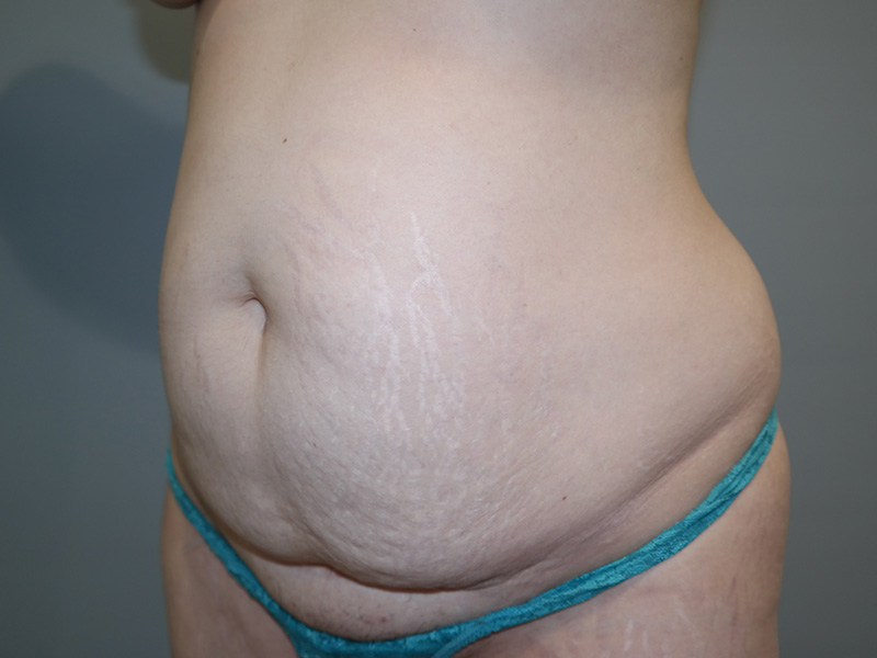 Tummy Tuck Before and After 11 | Sanjay Grover MD FACS