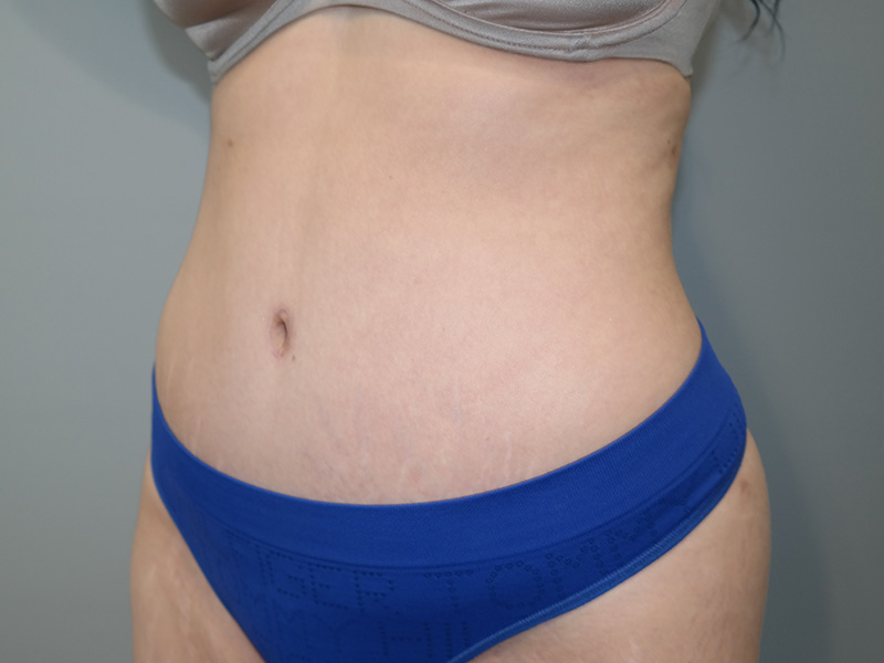 Tummy Tuck Before and After 11 | Grover Aesthetics