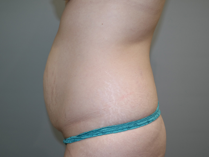 Tummy Tuck Before and After 11 | Grover Aesthetics