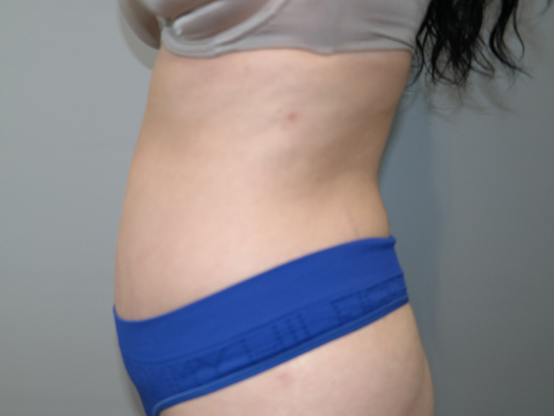 Tummy Tuck Before and After 11 | Grover Aesthetics