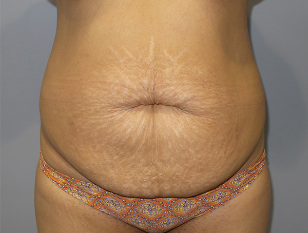 Tummy Tuck Before and After | Grover Aesthetics