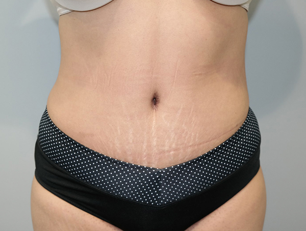 Tummy Tuck Before and After | Grover Aesthetics