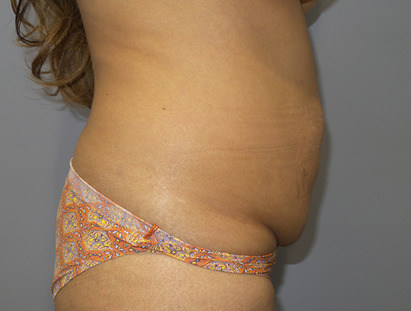 Tummy Tuck Before and After 110 | Grover Aesthetics