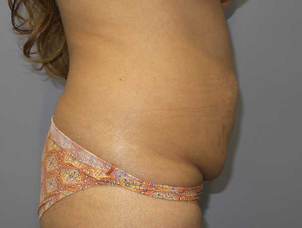 Tummy Tuck Before and After 110 | Sanjay Grover MD FACS