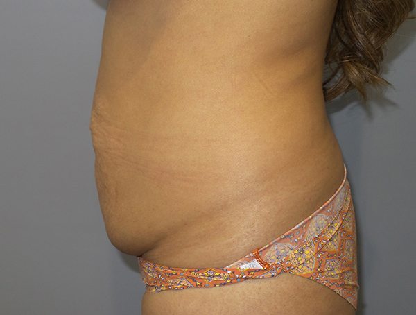 Tummy Tuck Before and After 110 | Sanjay Grover MD FACS