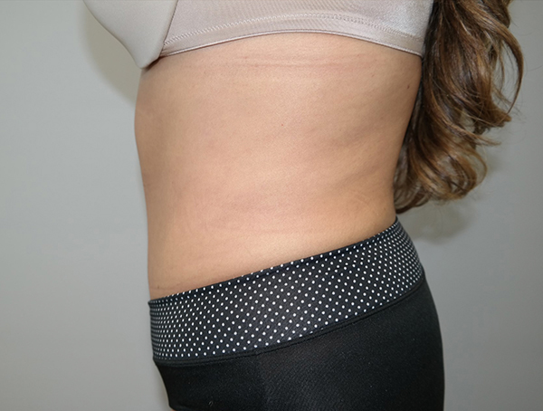 Tummy Tuck Before and After 110 | Sanjay Grover MD FACS