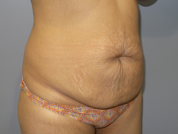 Tummy Tuck Before and After 110 | Sanjay Grover MD FACS