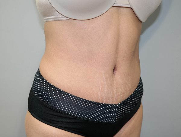 Tummy Tuck Before and After 110 | Sanjay Grover MD FACS