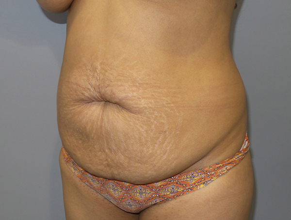 Tummy Tuck Before and After 110 | Sanjay Grover MD FACS