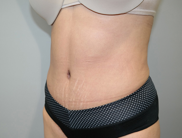 Tummy Tuck Before and After 110 | Grover Aesthetics