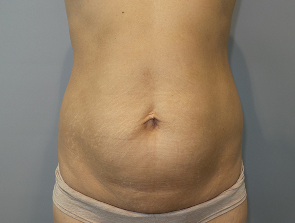 Tummy Tuck Before and After 88 | Sanjay Grover MD FACS