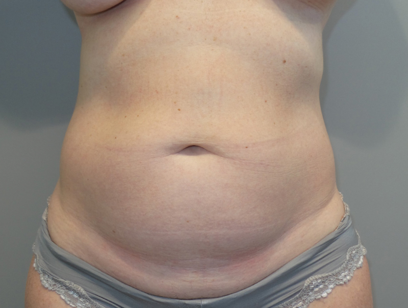 Tummy Tuck Before and After 07 | Sanjay Grover MD FACS