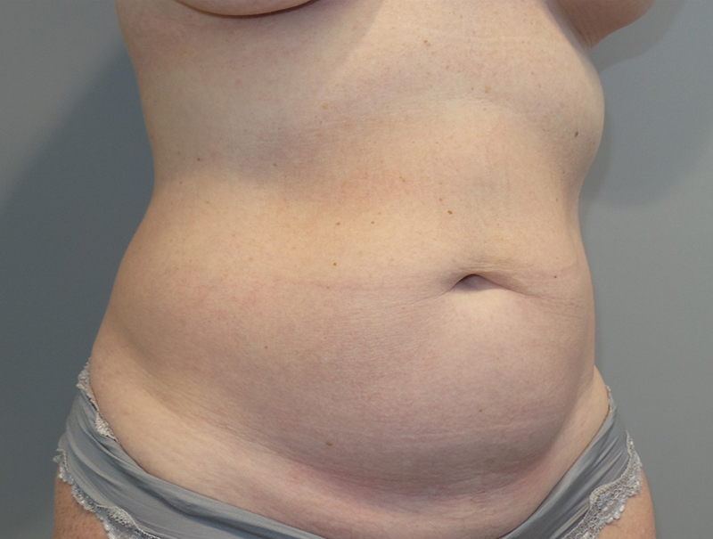 Tummy Tuck Before and After 111 | Sanjay Grover MD FACS