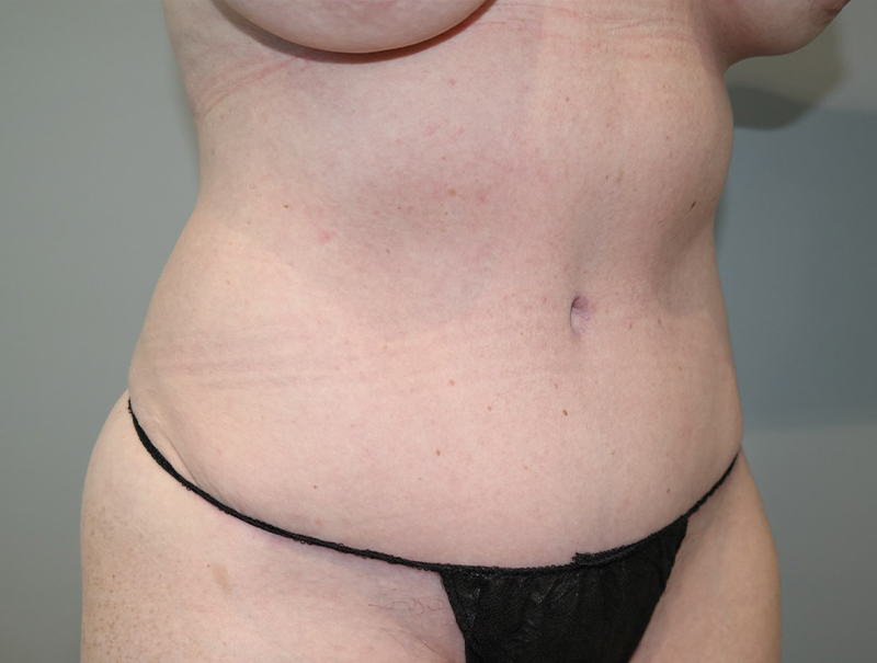 Tummy Tuck Before and After 111 | Grover Aesthetics