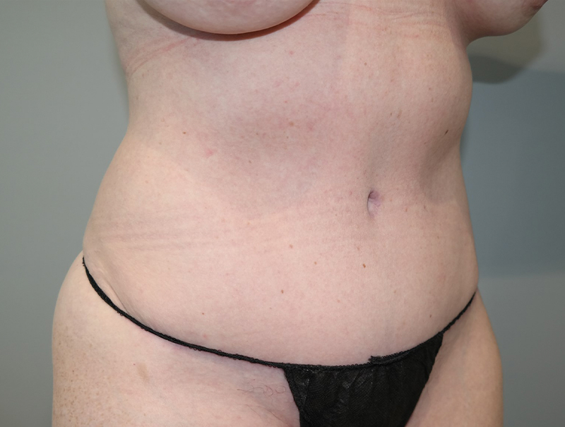 Tummy Tuck Before and After 111 | Sanjay Grover MD FACS