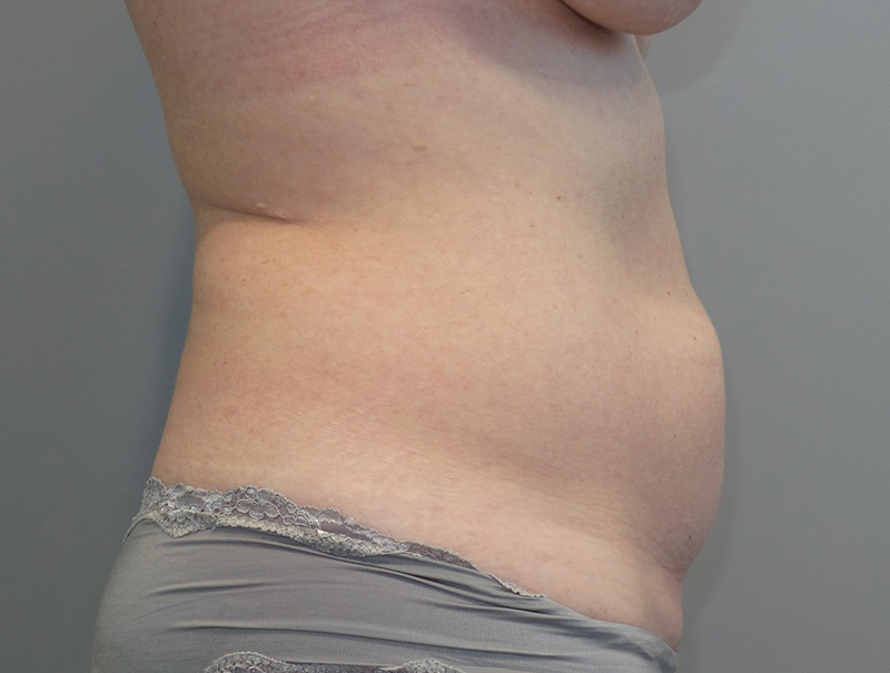 Tummy Tuck Before and After 111 | Sanjay Grover MD FACS