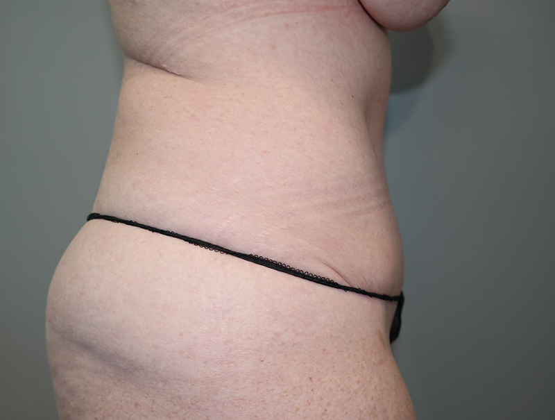 Tummy Tuck Before and After 111 | Sanjay Grover MD FACS