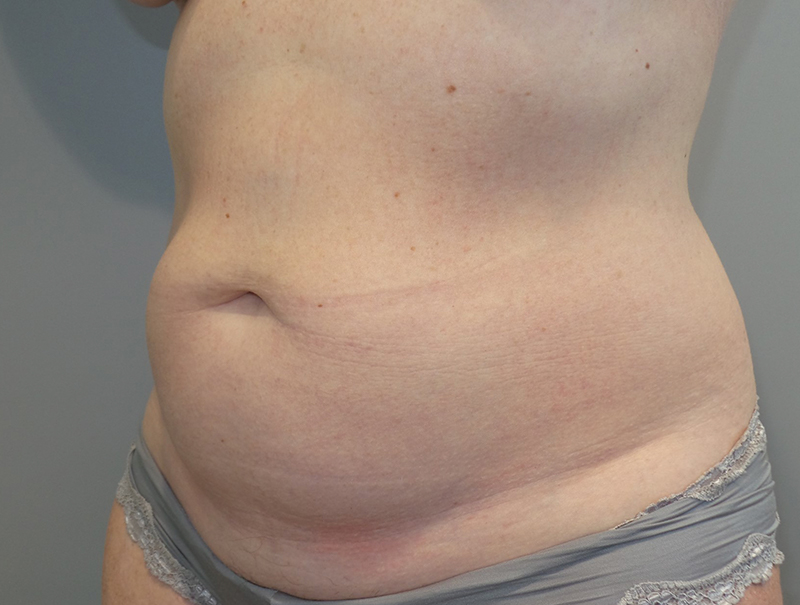 Tummy Tuck Before and After 111 | Sanjay Grover MD FACS