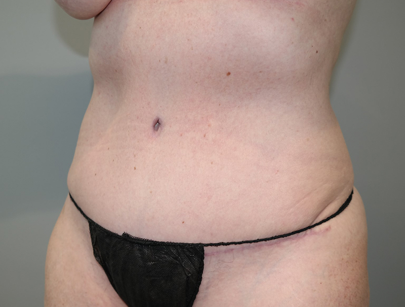 Tummy Tuck Before and After 111 | Sanjay Grover MD FACS