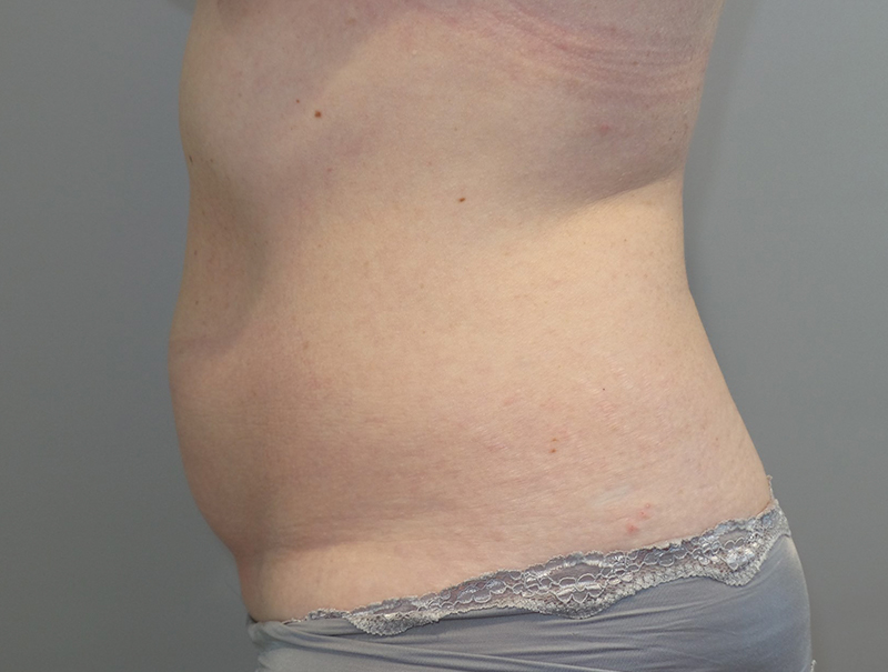 Tummy Tuck Before and After 111 | Sanjay Grover MD FACS