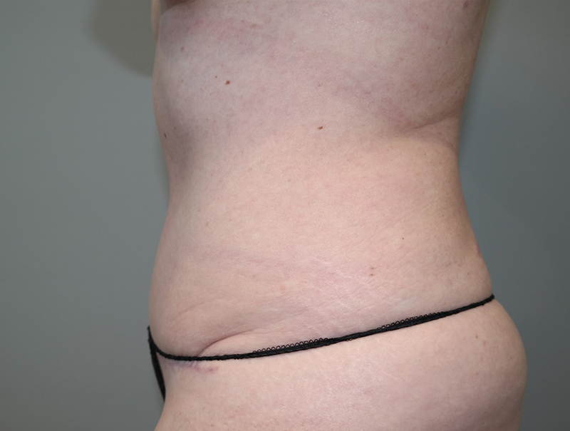 Tummy Tuck Before and After 111 | Sanjay Grover MD FACS