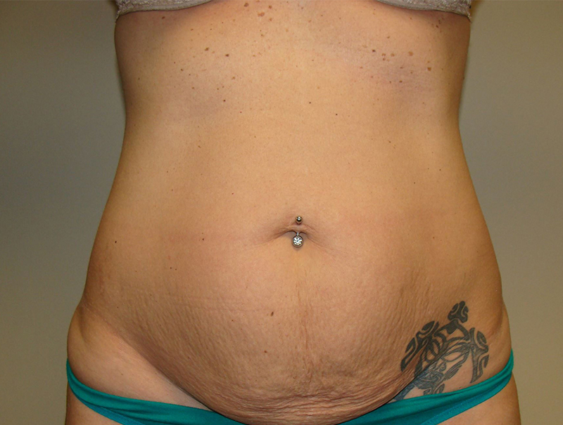 Tummy Tuck Before and After | Grover Aesthetics