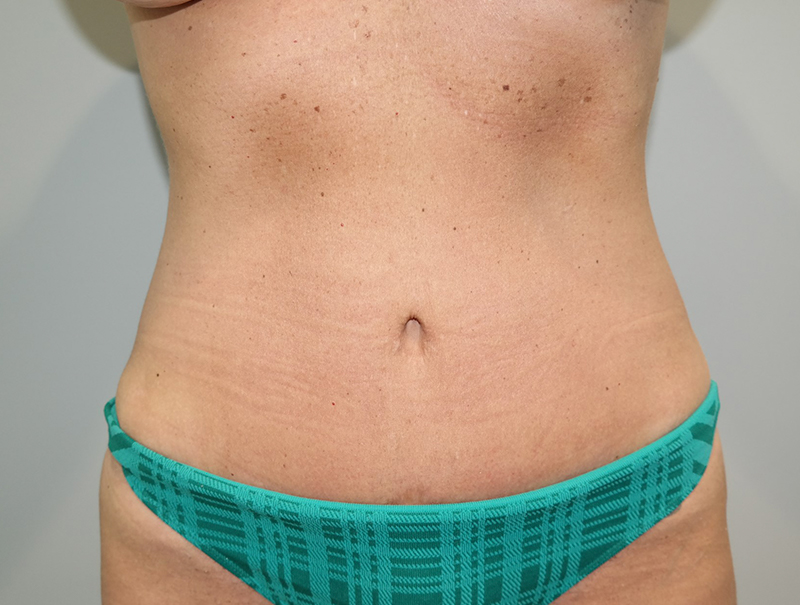 Tummy Tuck Before and After | Grover Aesthetics