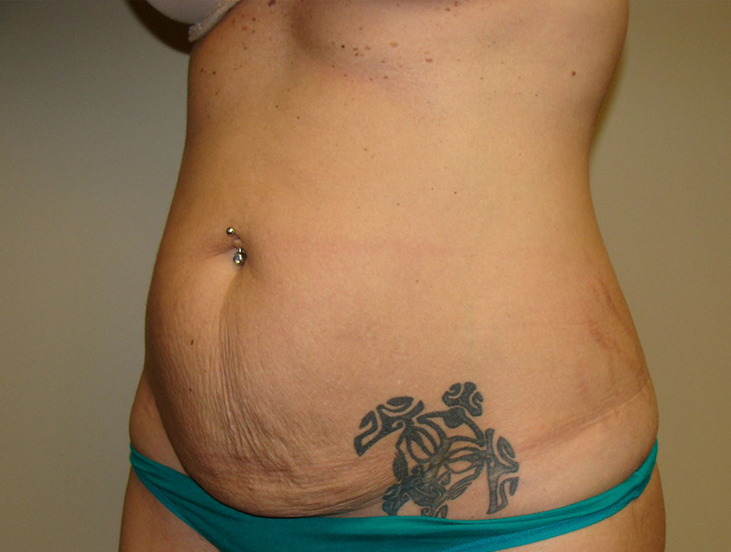 Tummy Tuck Before and After 112 | Grover Aesthetics