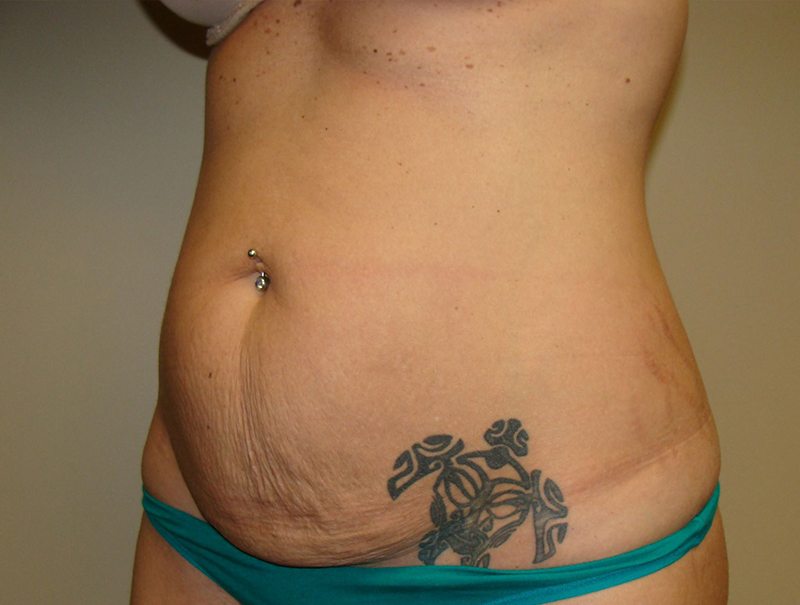 Tummy Tuck Before and After 112 | Sanjay Grover MD FACS