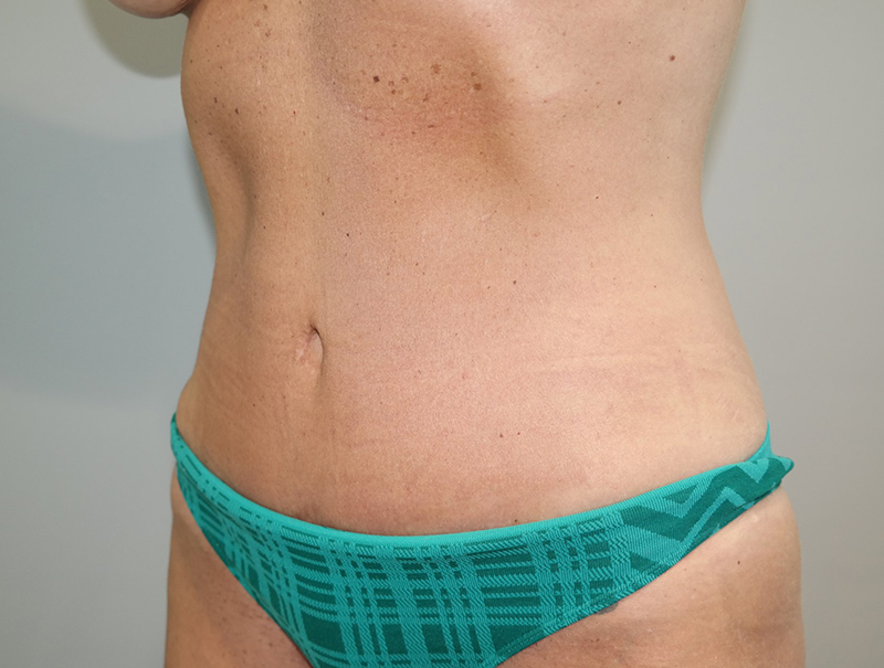 Tummy Tuck Before and After 112 | Sanjay Grover MD FACS