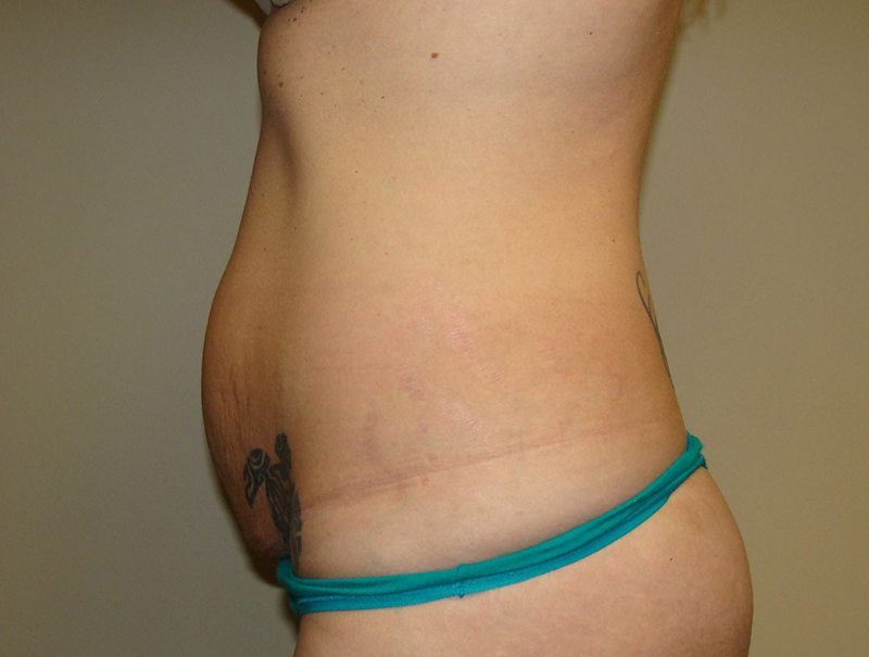 Tummy Tuck Before and After 112 | Sanjay Grover MD FACS