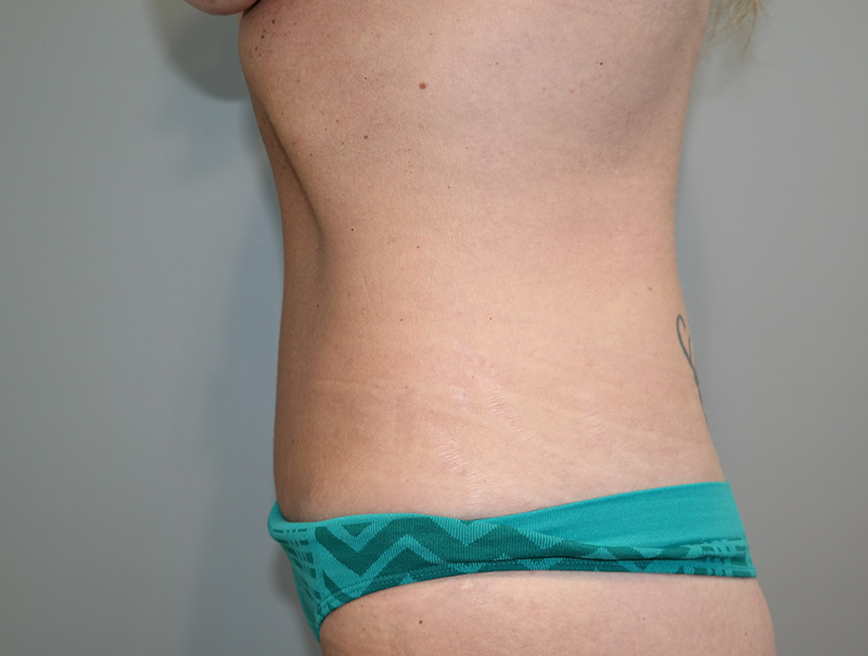 Tummy Tuck Before and After 112 | Sanjay Grover MD FACS