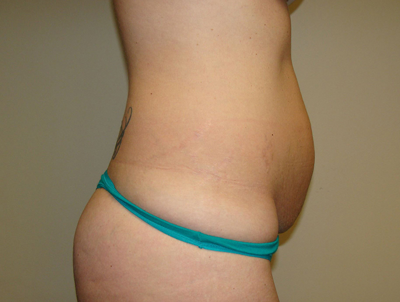 Tummy Tuck Before and After 112 | Sanjay Grover MD FACS