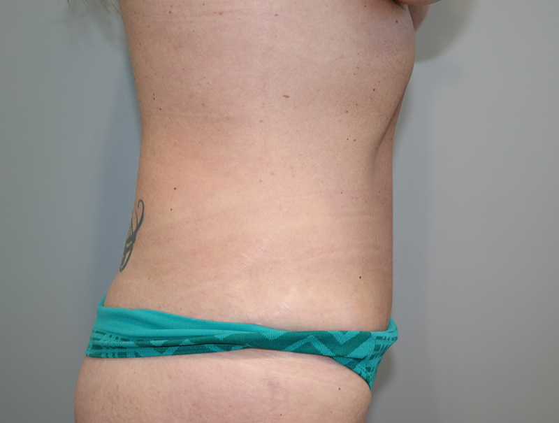 Tummy Tuck Before and After 112 | Sanjay Grover MD FACS