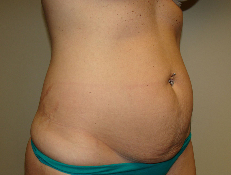 Tummy Tuck Before and After 112 | Grover Aesthetics
