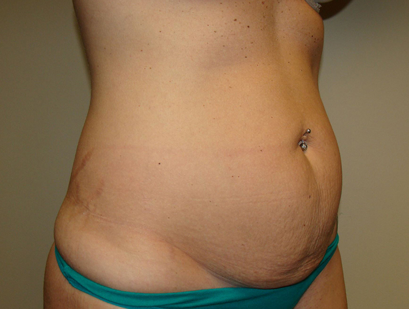 Tummy Tuck Before and After 112 | Sanjay Grover MD FACS